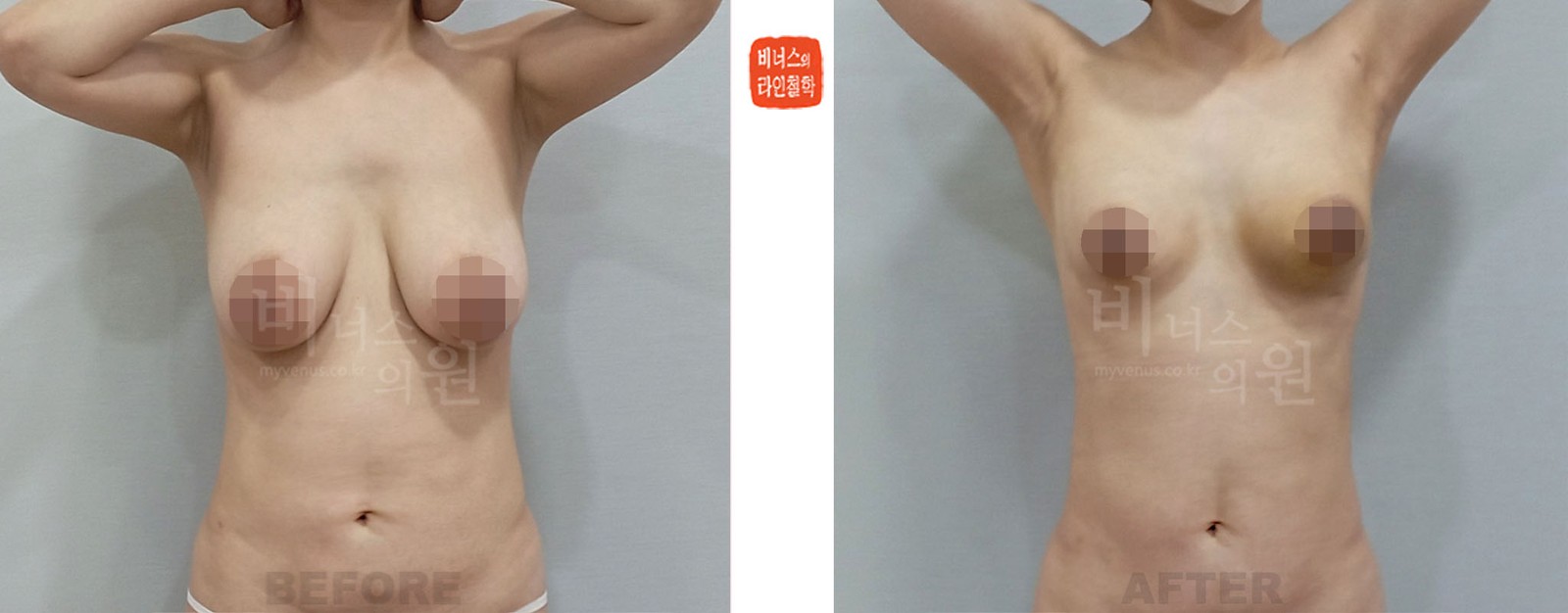 产后下垂乳房吸脂缩胸手术前后照片 正面（术后1周）