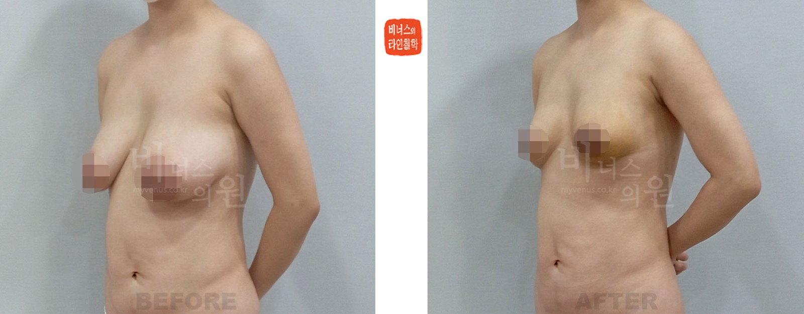 产后下垂乳房吸脂缩胸手术前后照片 斜面（术后1周）
