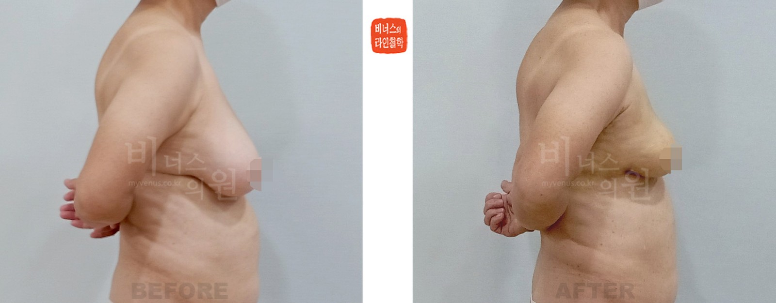 乳腺癌术后双侧乳房不对称吸脂矫正前后对比照片 右侧面（术后1周）