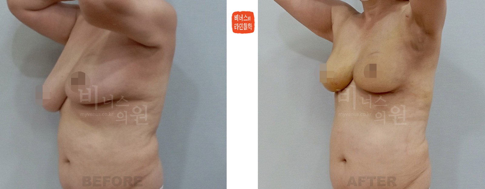 乳腺癌术后双侧乳房不对称吸脂矫正前后对比照片 左斜侧面（术后1周）