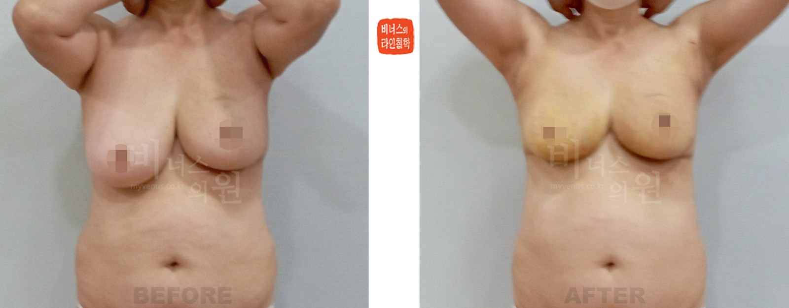 乳腺癌术后双侧乳房不对称吸脂矫正前后对比照片 正面（术后1周）