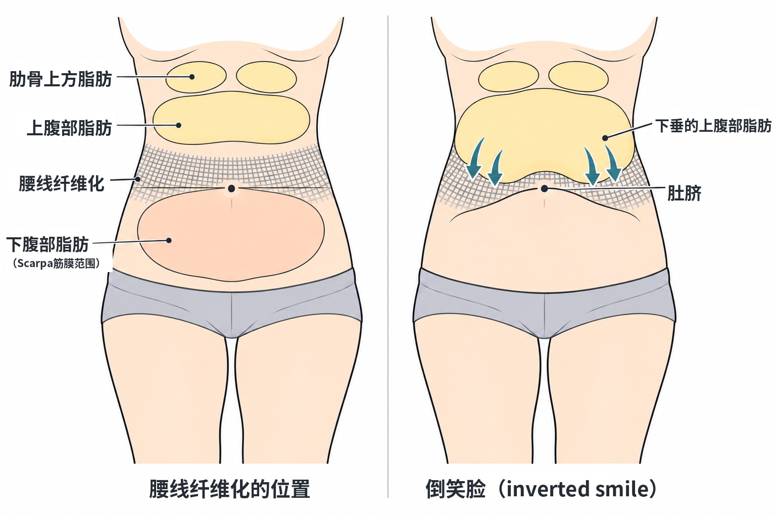腰线纤维化的位置及倒笑脸形态形成原理的示意图