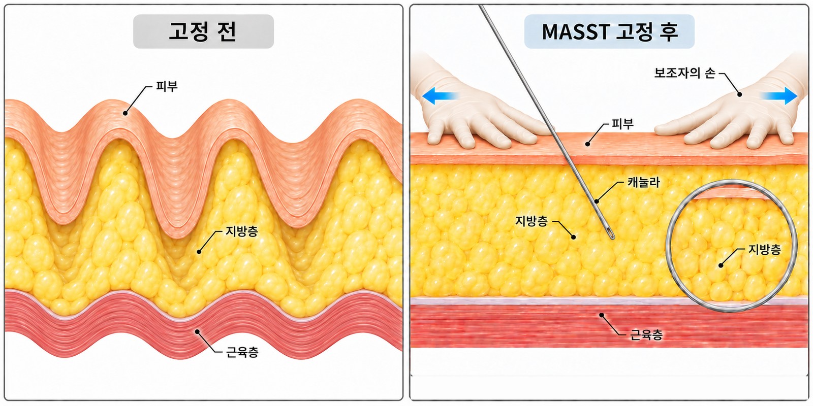 MASST 剖面图——助手用手把像窗帘一样起伏的脂肪层展平固定的原理