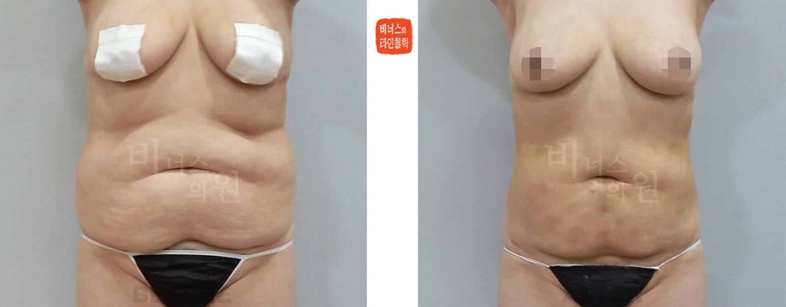 360度圆筒形沙漏型腹部吸脂前后照片 正面（术后1周）
