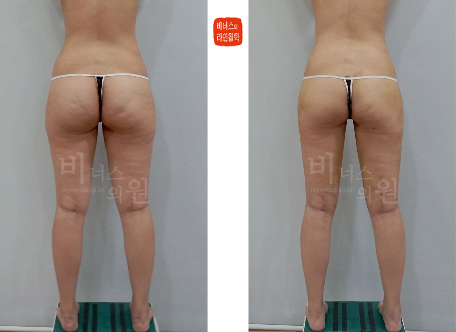 圆柱形大腿和臀部吸脂前后对比照片 第一个病例 背面(术后1周)