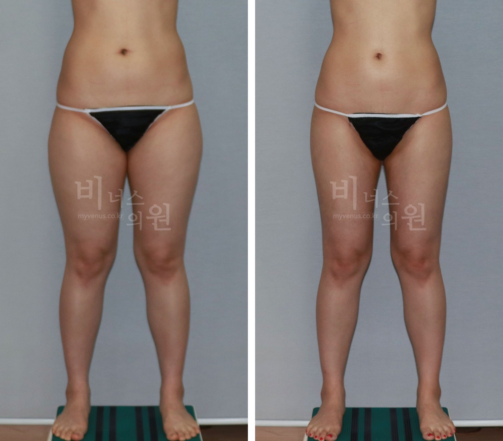 圆柱形大腿吸脂前后对比照片 第二个病例 正面(术后3个月)