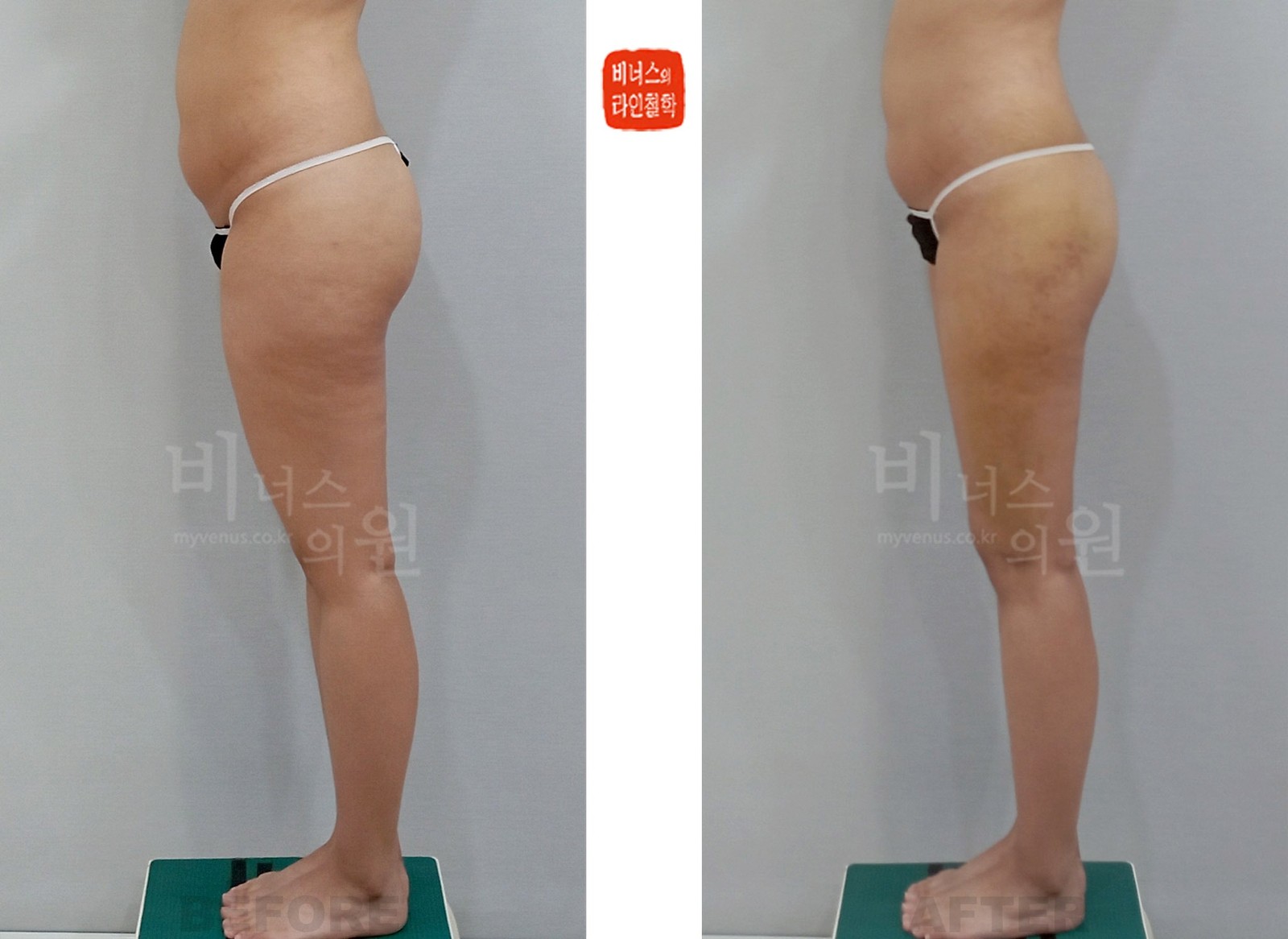 圆柱形大腿和臀部吸脂前后对比照片 第一个病例 左侧面(术后1周)