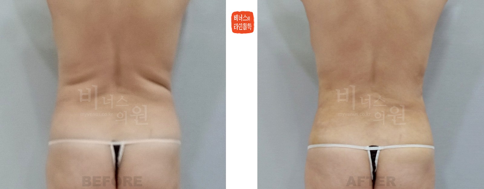腹部吸脂手术前后对比照片 后面（术后1周）