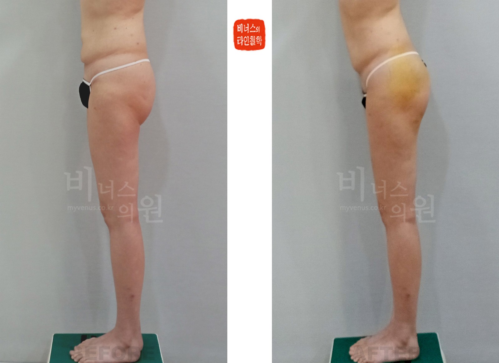 大腿双重臀下皱襞矫正 臀部吸脂·脂肪移植前后对比照片 左侧面（术后 1 周）