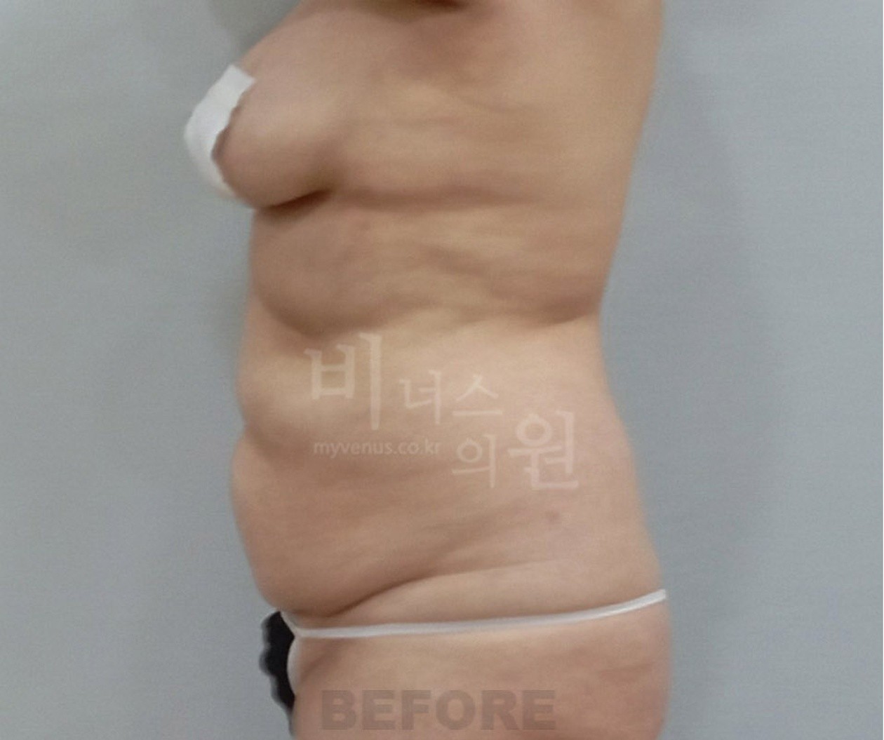 腹部吸脂术前 侧面