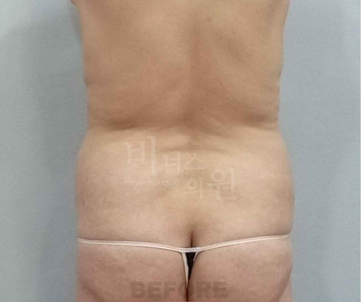腹部吸脂术前 背面