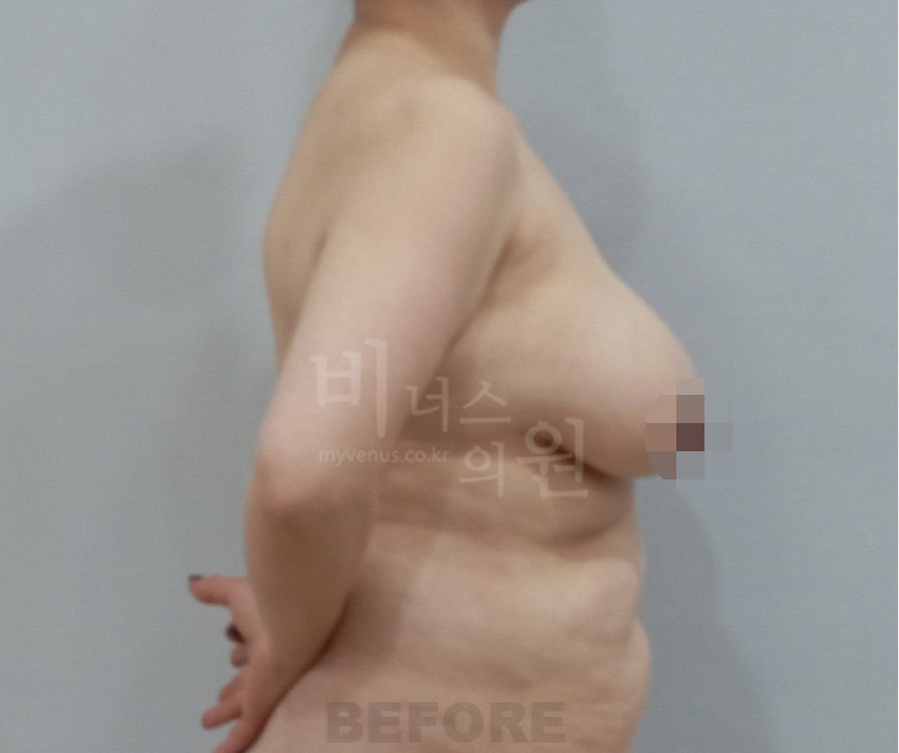 乳房吸脂术前 侧面