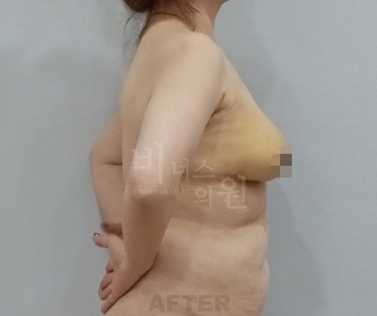 乳房吸脂术后 侧面