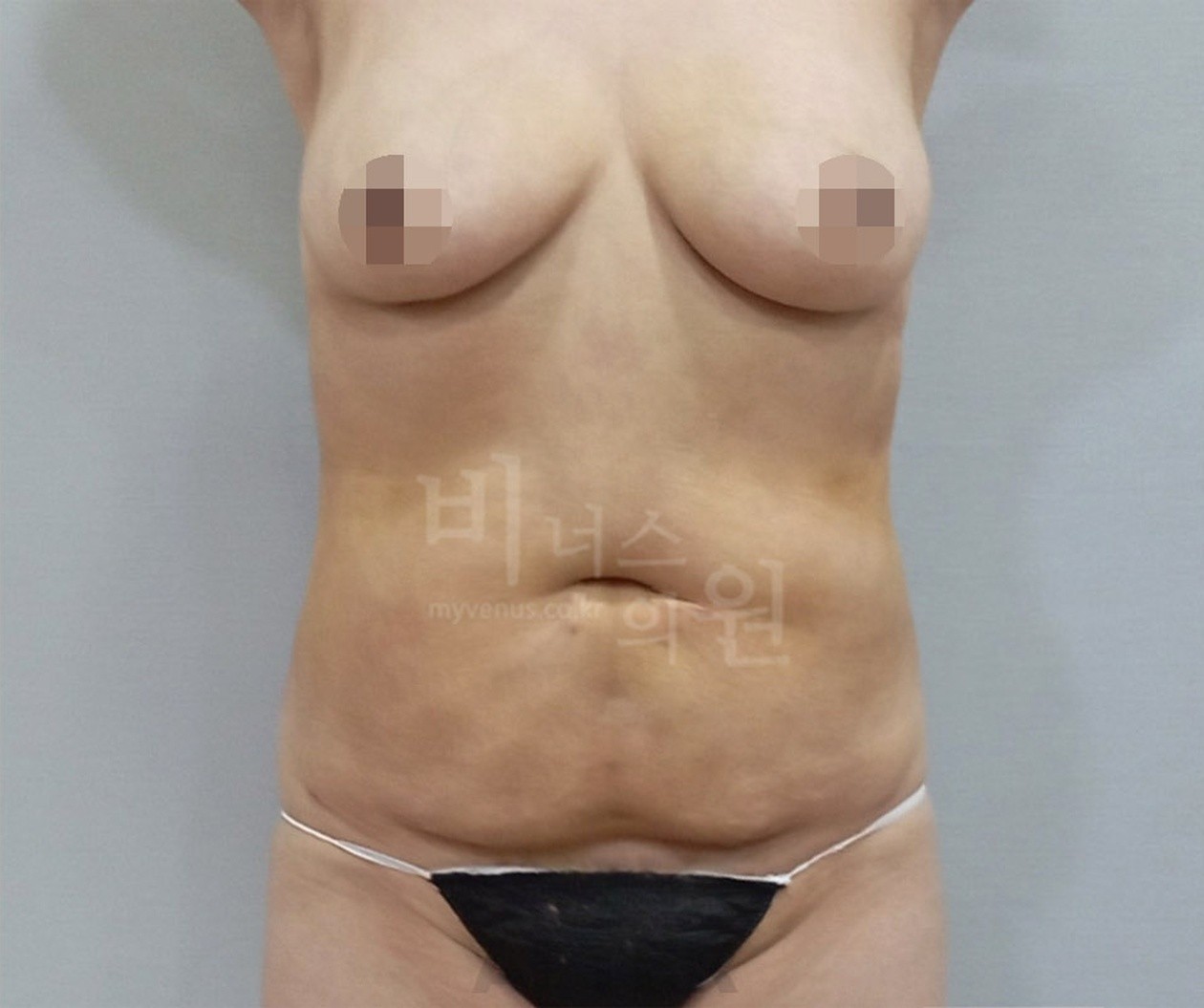 腹部吸脂术后 正面