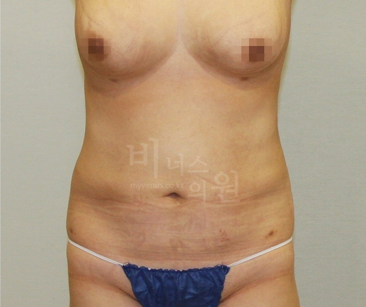 腹部吸脂术后 正面（2012年拍摄）