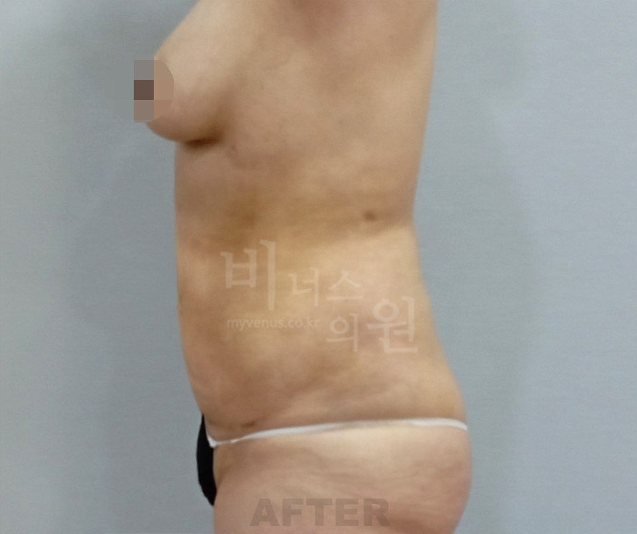 腹部吸脂术后 侧面