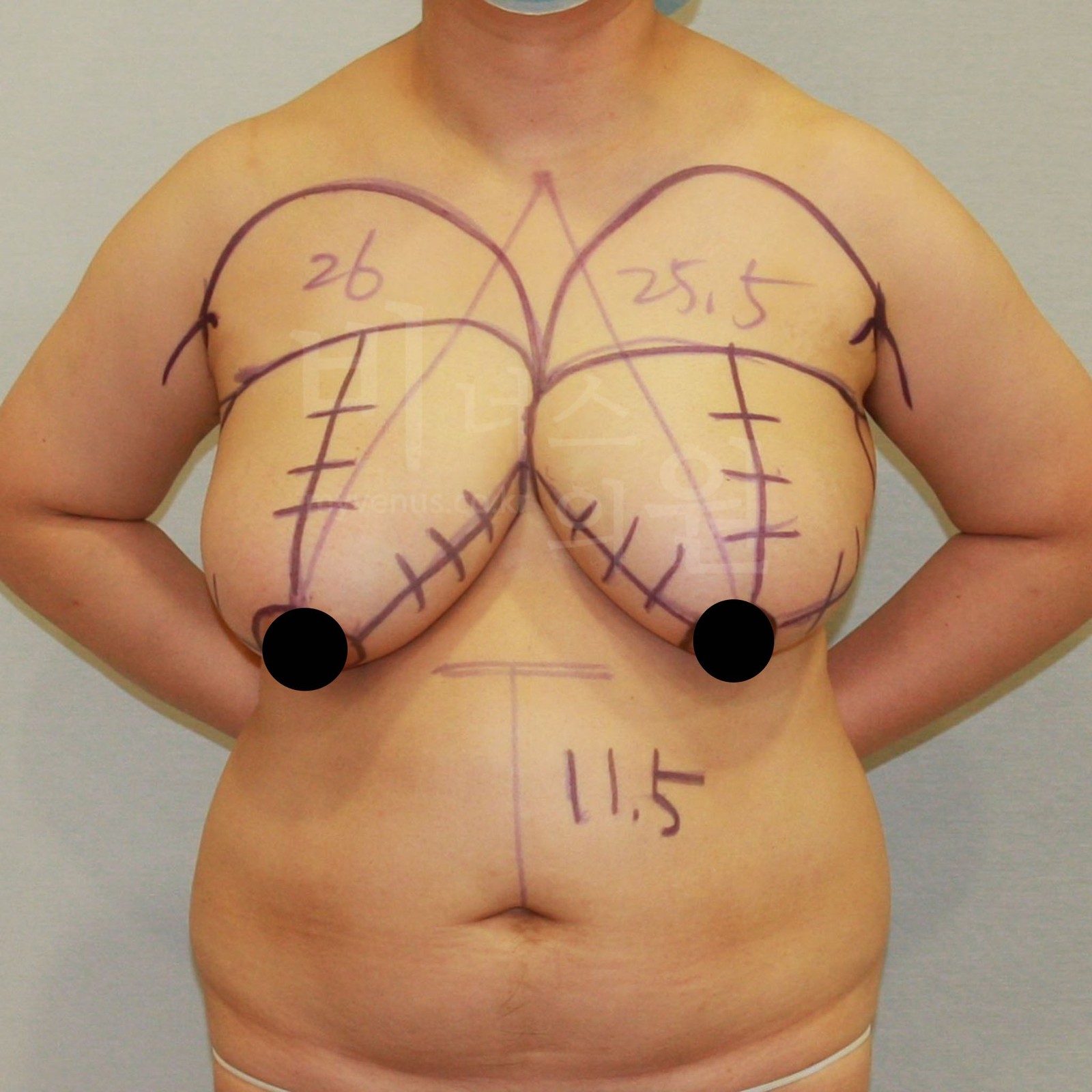 乳房吸脂术前 正面（2011年拍摄）