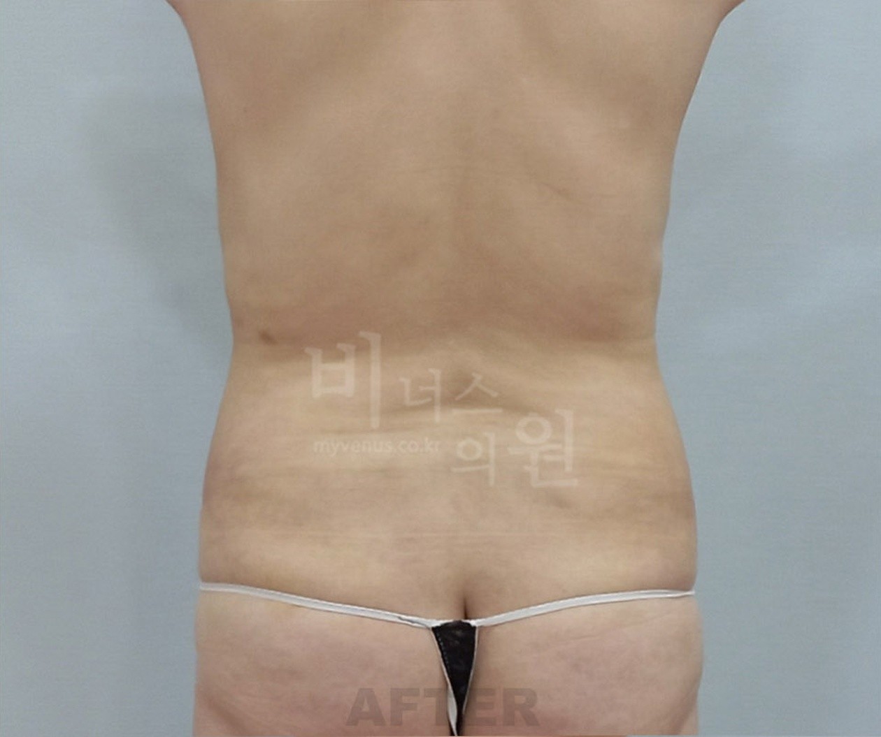 腹部吸脂术后 背面