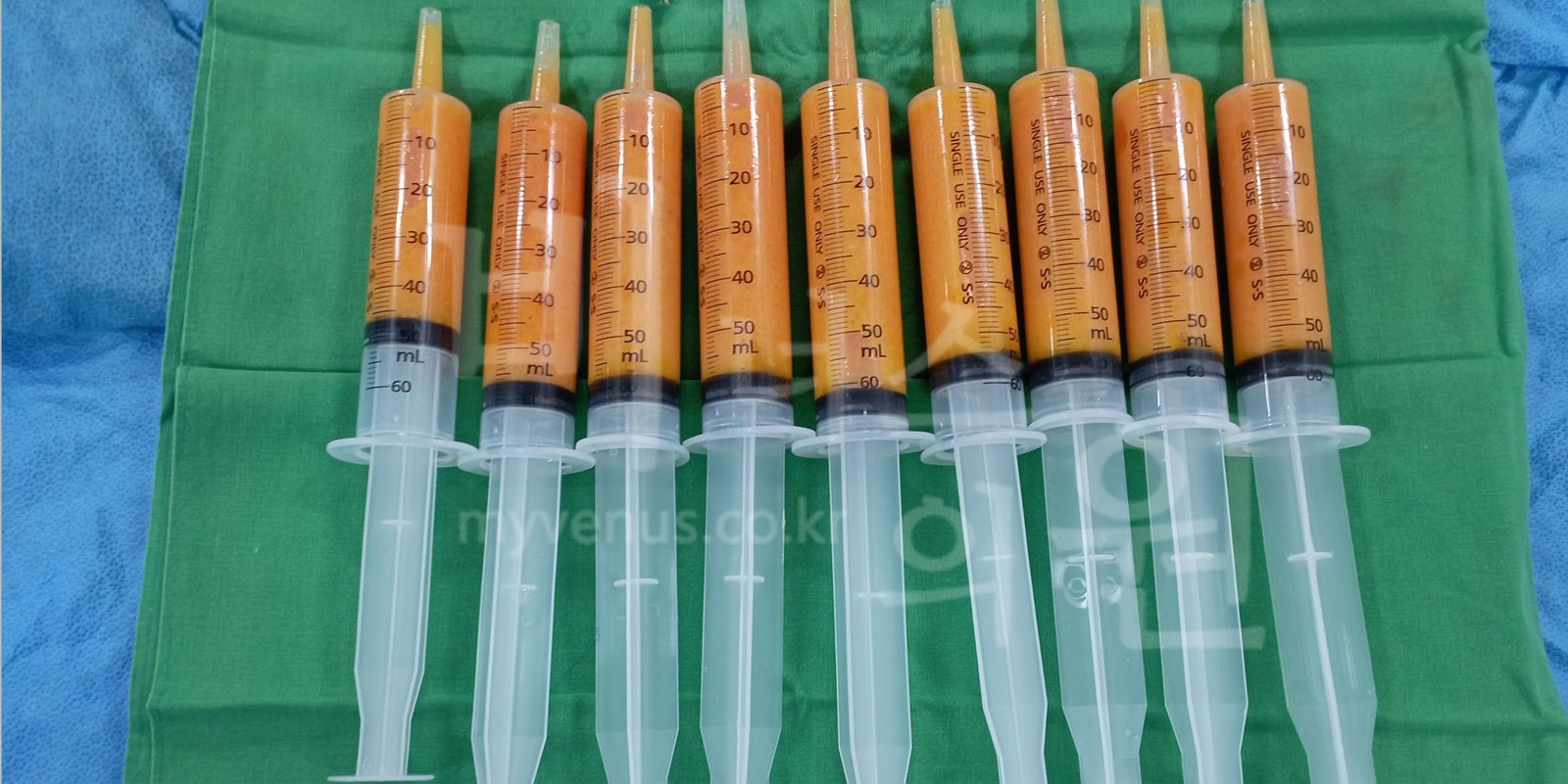 装有注射器吸脂所采集脂肪的9支60mL注射器