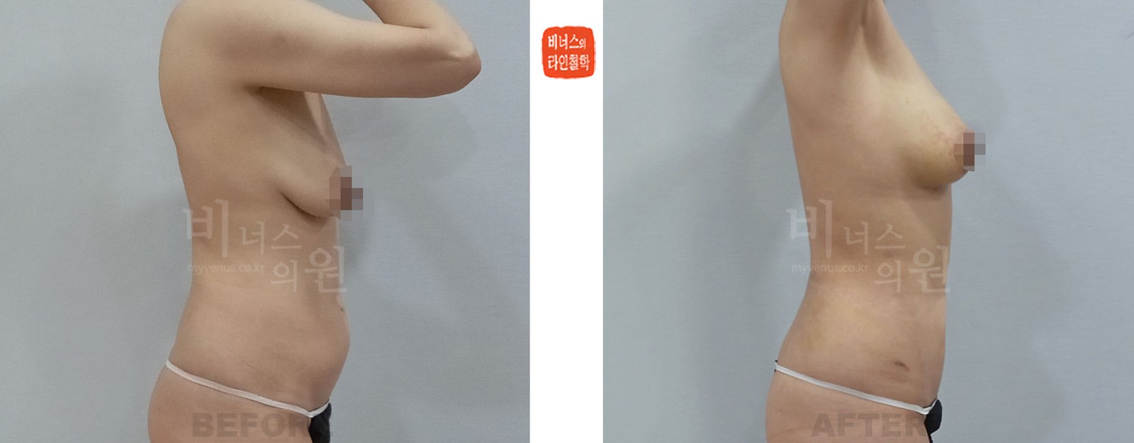 腹部吸脂与乳房脂肪移植前后对比照片 右侧面(术后1周)