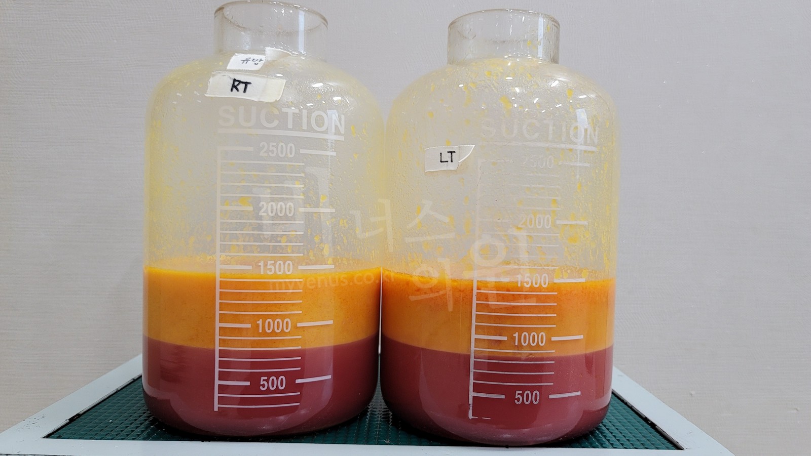 使用吸引器的吸脂(SAL)中收集在吸引瓶里的脂肪和下层的液体