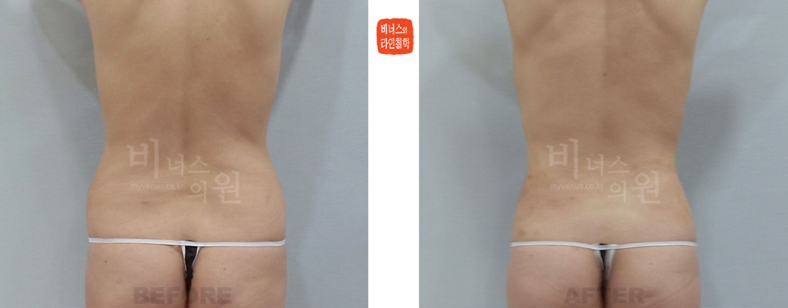 腹部吸脂与乳房脂肪移植前后对比照片 背面(术后1周)