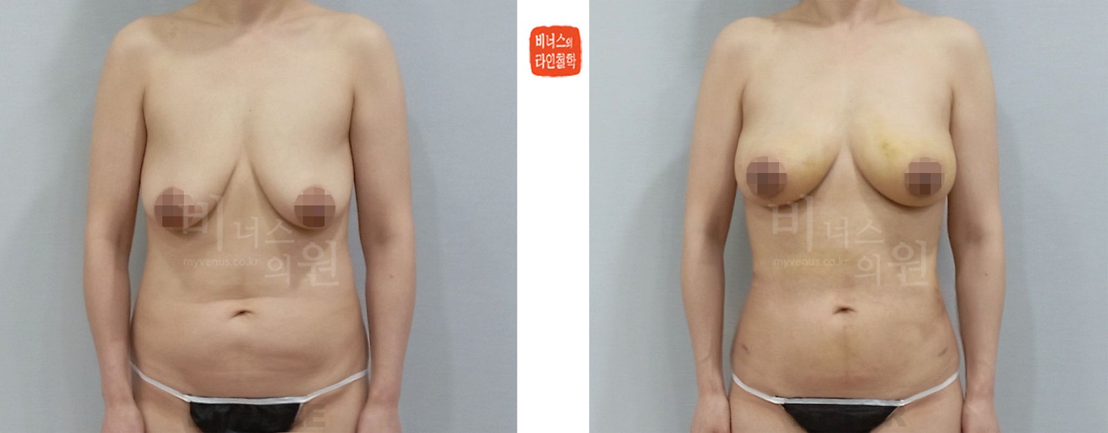 腹部吸脂与乳房脂肪移植前后对比照片 正面(术后1周)