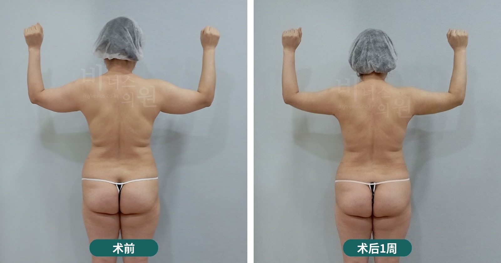 手臂吸脂前后对比照片第一个病例——举起手臂的背面（术后1周）
