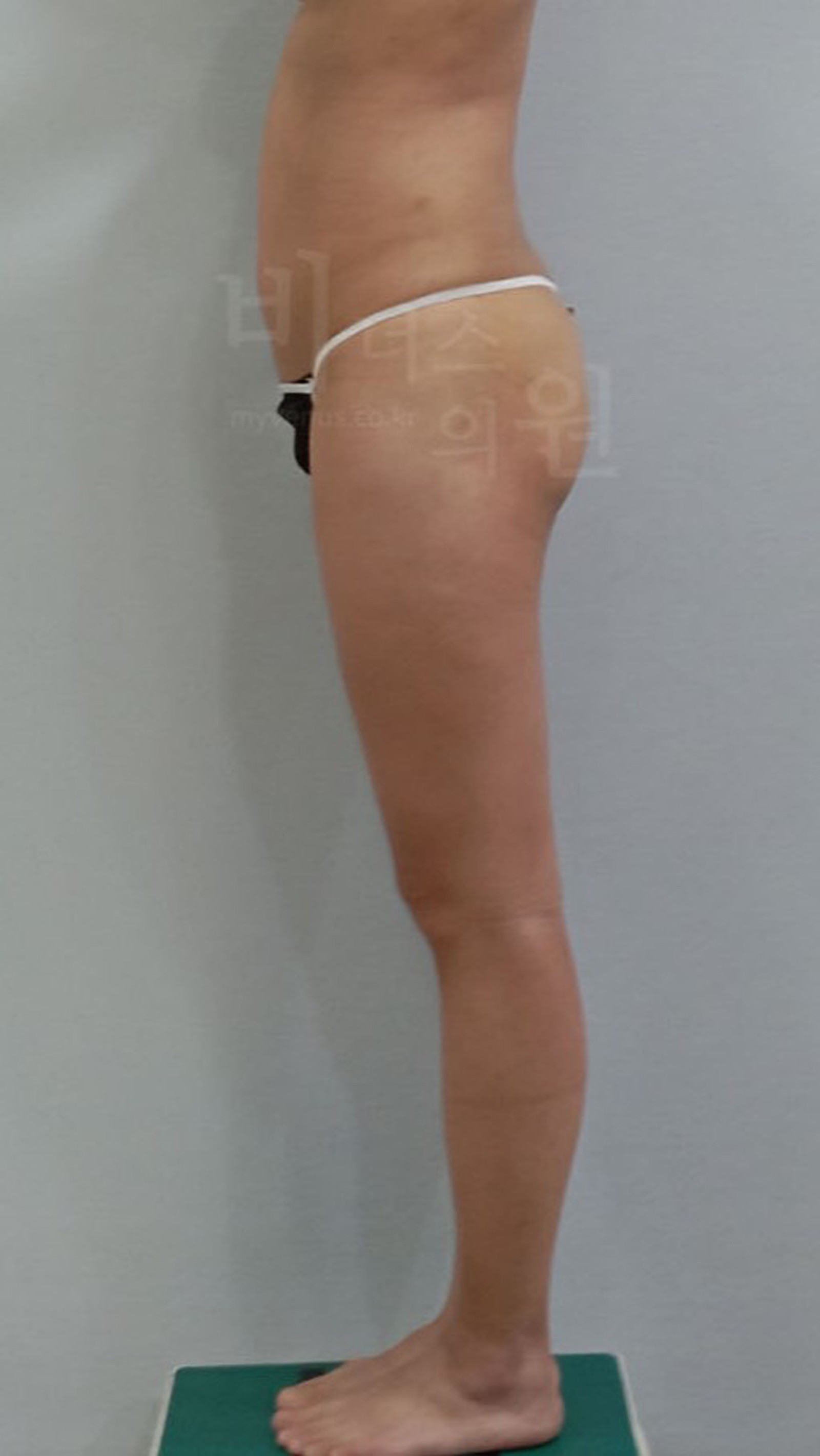 臀部下垂吸脂术后1周侧面观
