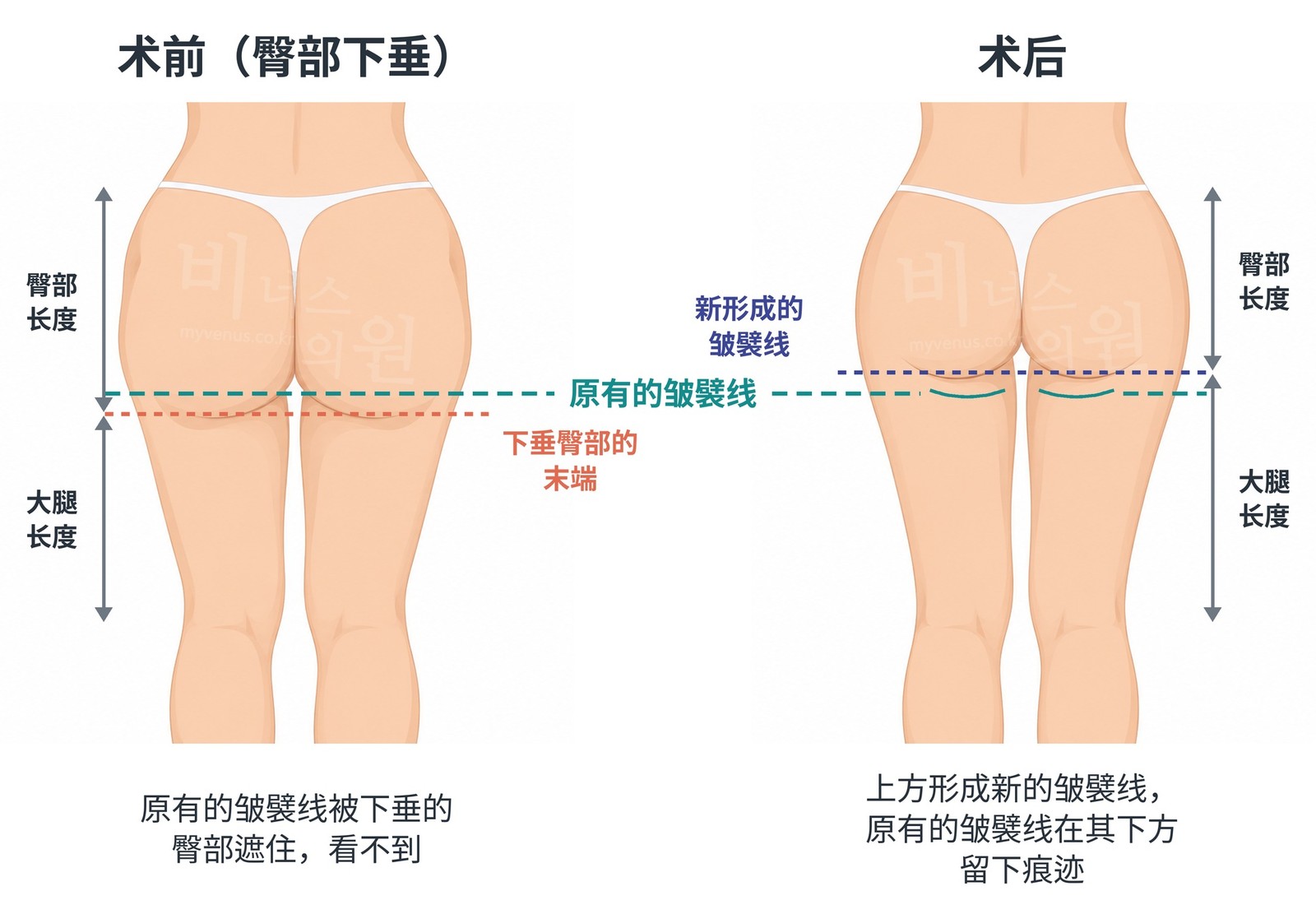 臀部下垂吸脂术前与术后的后面观对比——术后在上方新形成的皱襞线，以及在其下方作为痕迹留下的原有的皱襞线