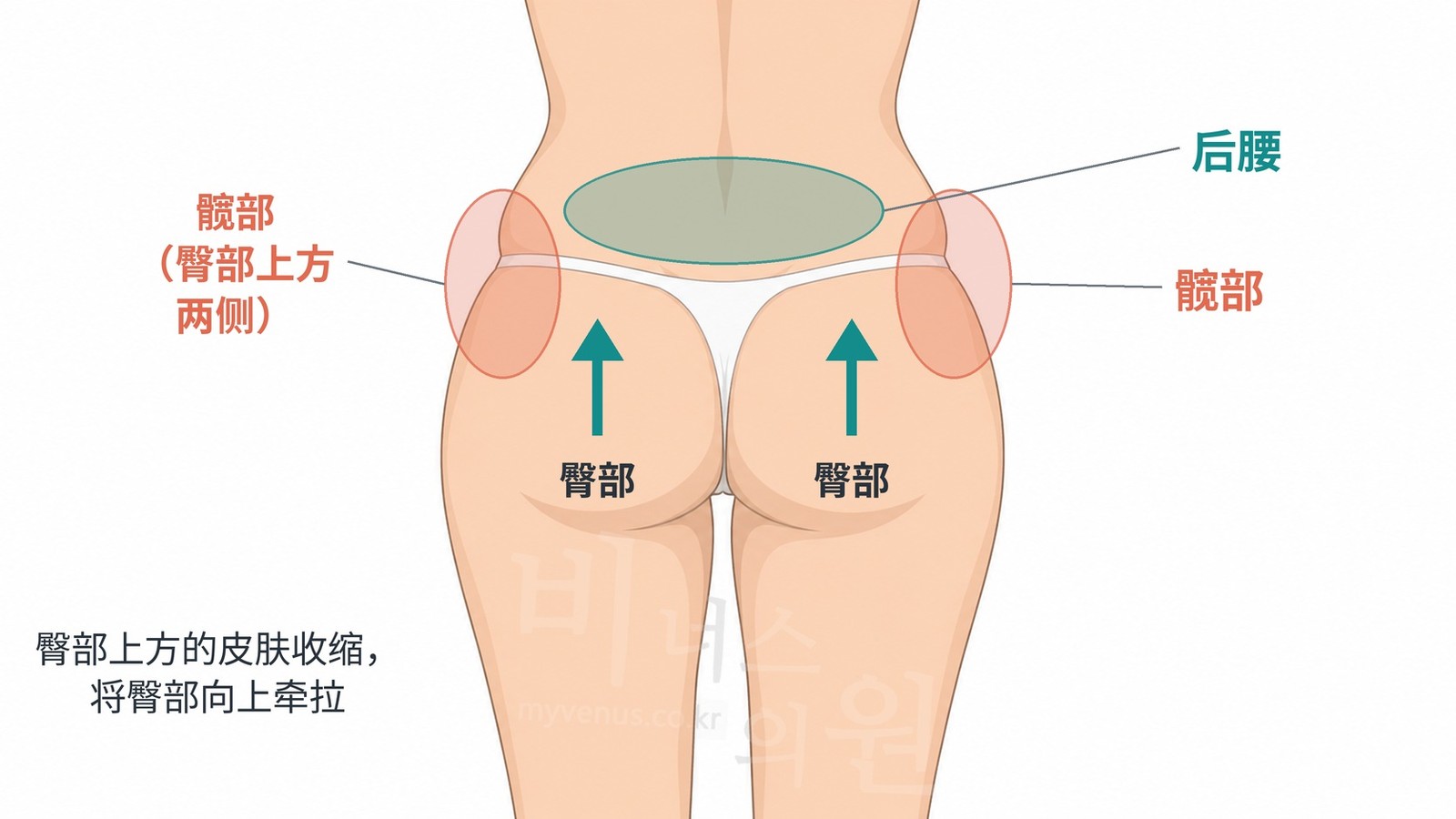 从后面看髋部、后腰和臀部的位置，以及吸脂后皮肤收缩、把臀部向上拉的方向