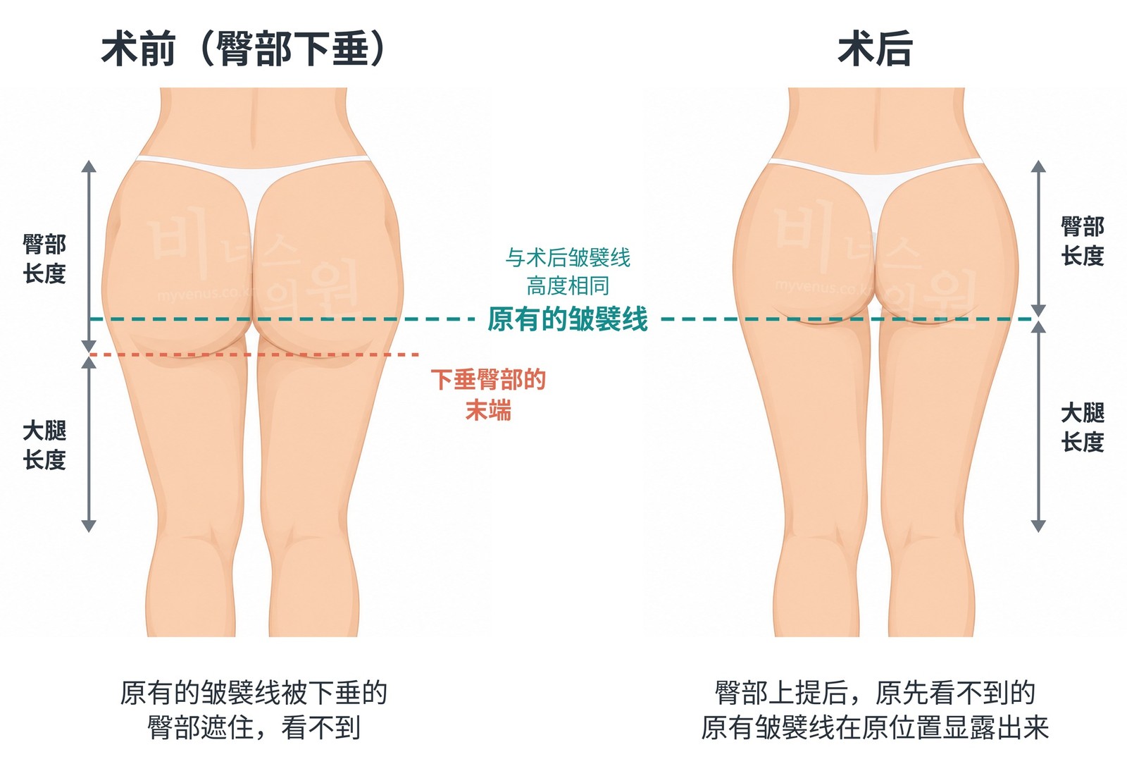 臀部下垂吸脂术前与术后的后面观对比——原先藏在下垂臀部里的原有的皱襞线与术后皱襞线高度相同的情况