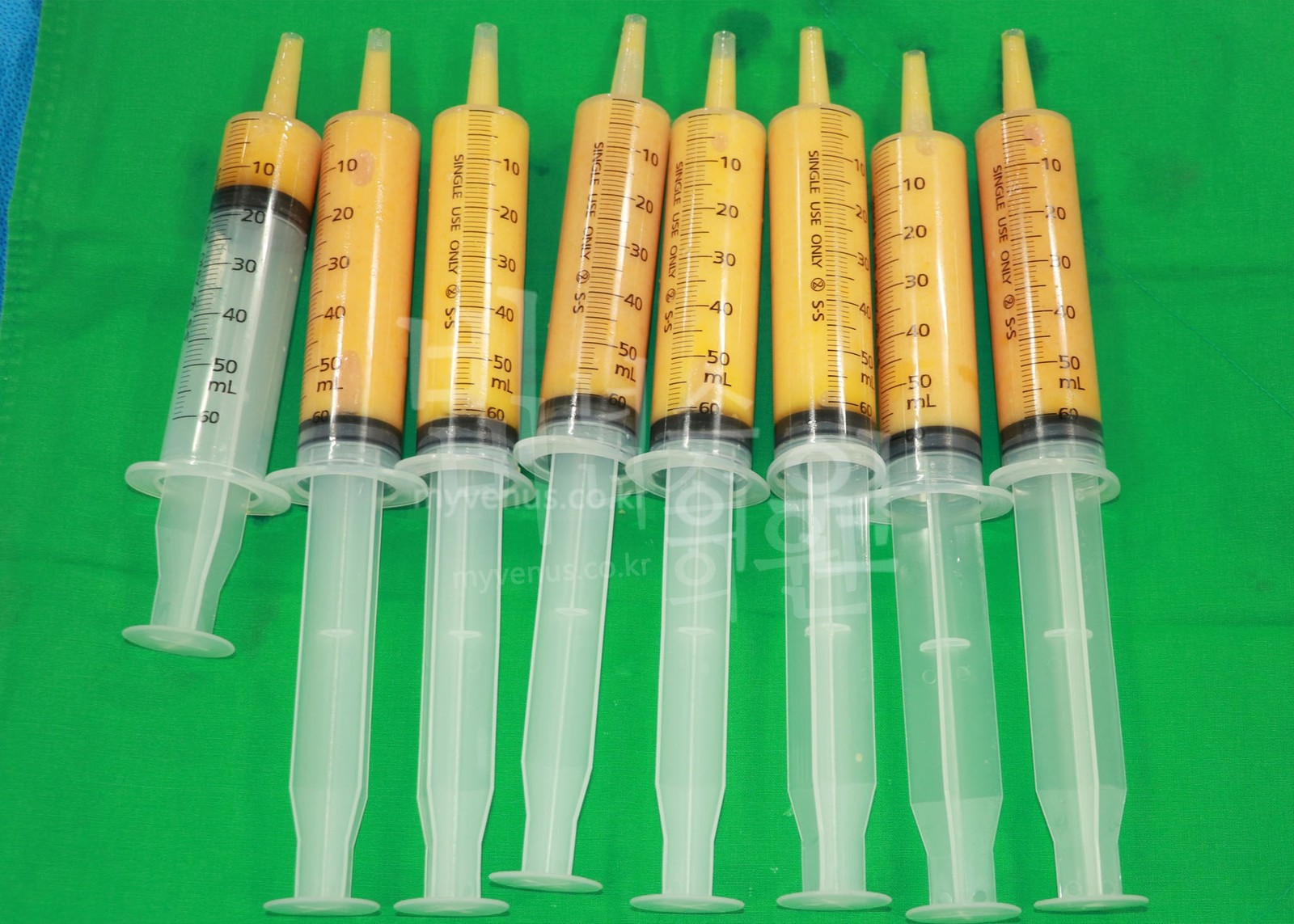 用注射器吸脂去除的脂肪