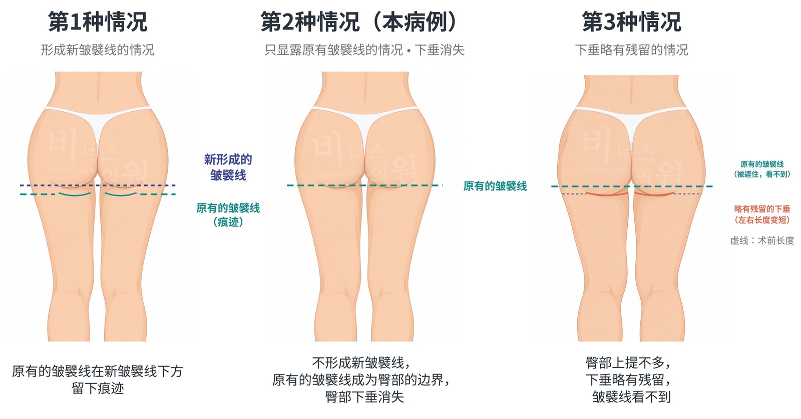 术后皱襞线三种样子的对比——第1种形成新皱襞线，第2种只显露出原有的皱襞线，第3种下垂略有残留的情况