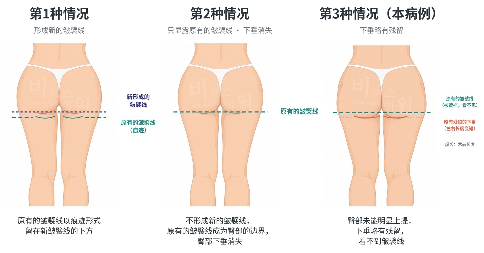 臀部下垂吸脂后皱襞线显露的三种情况对比——本病例为第3种情况