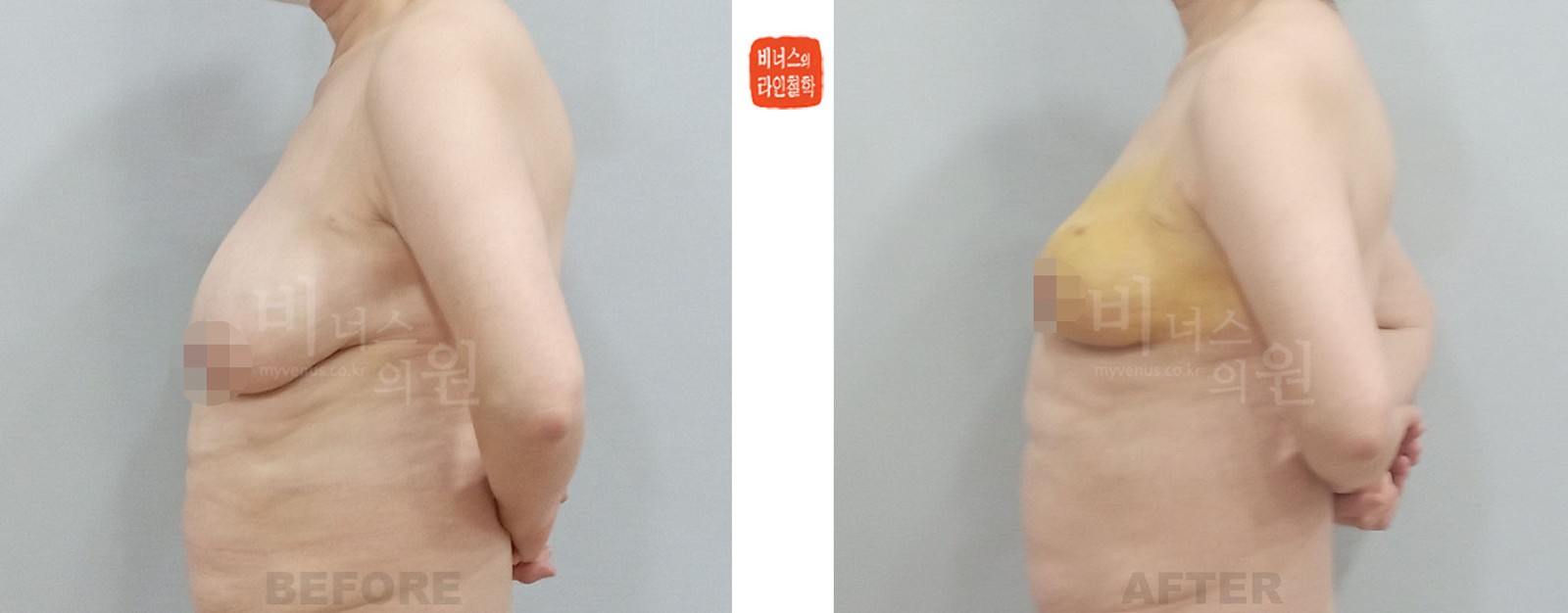 乳房不对称左侧吸脂手术前后对比 左侧面（术后1周）
