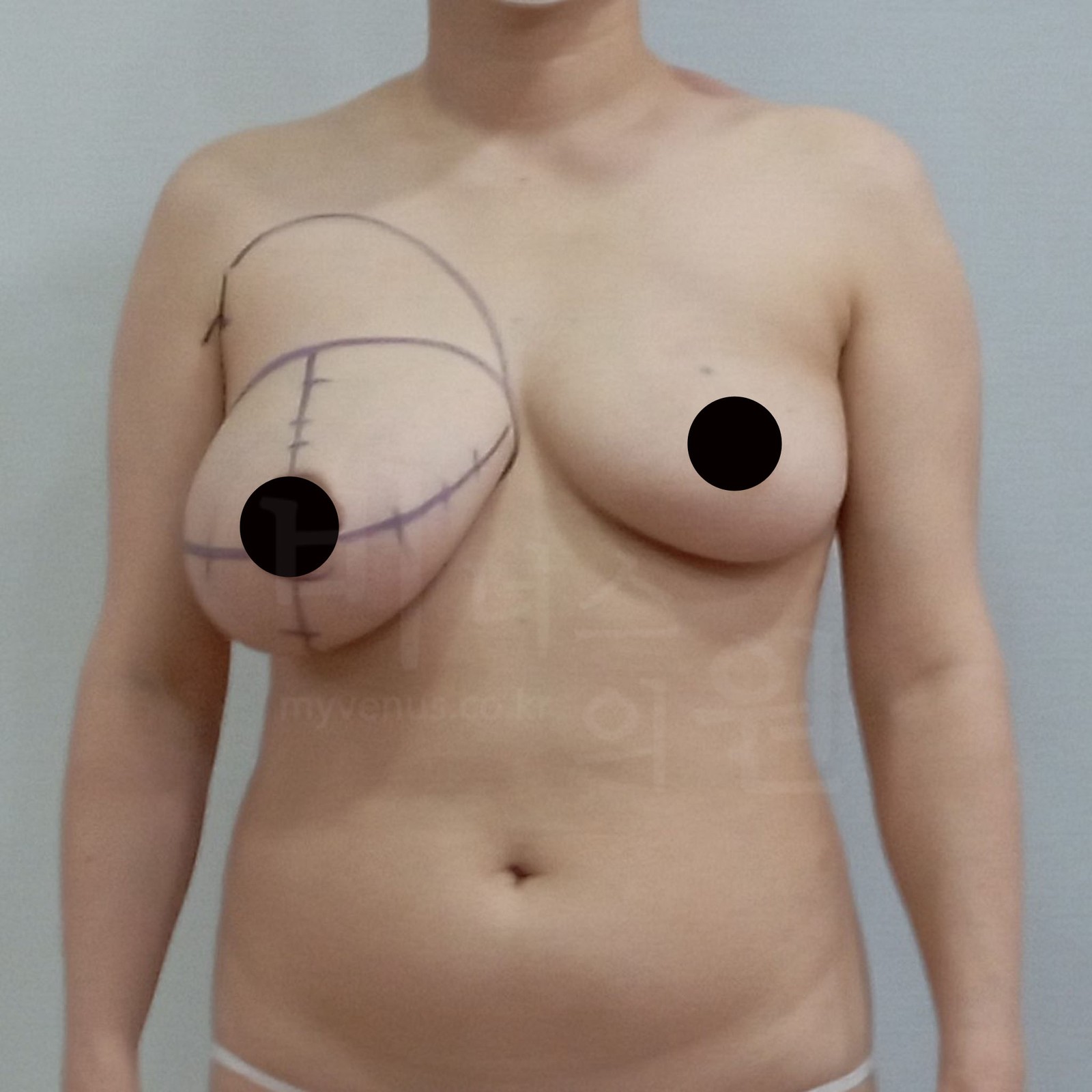 右侧乳房吸脂术前设计 正面
