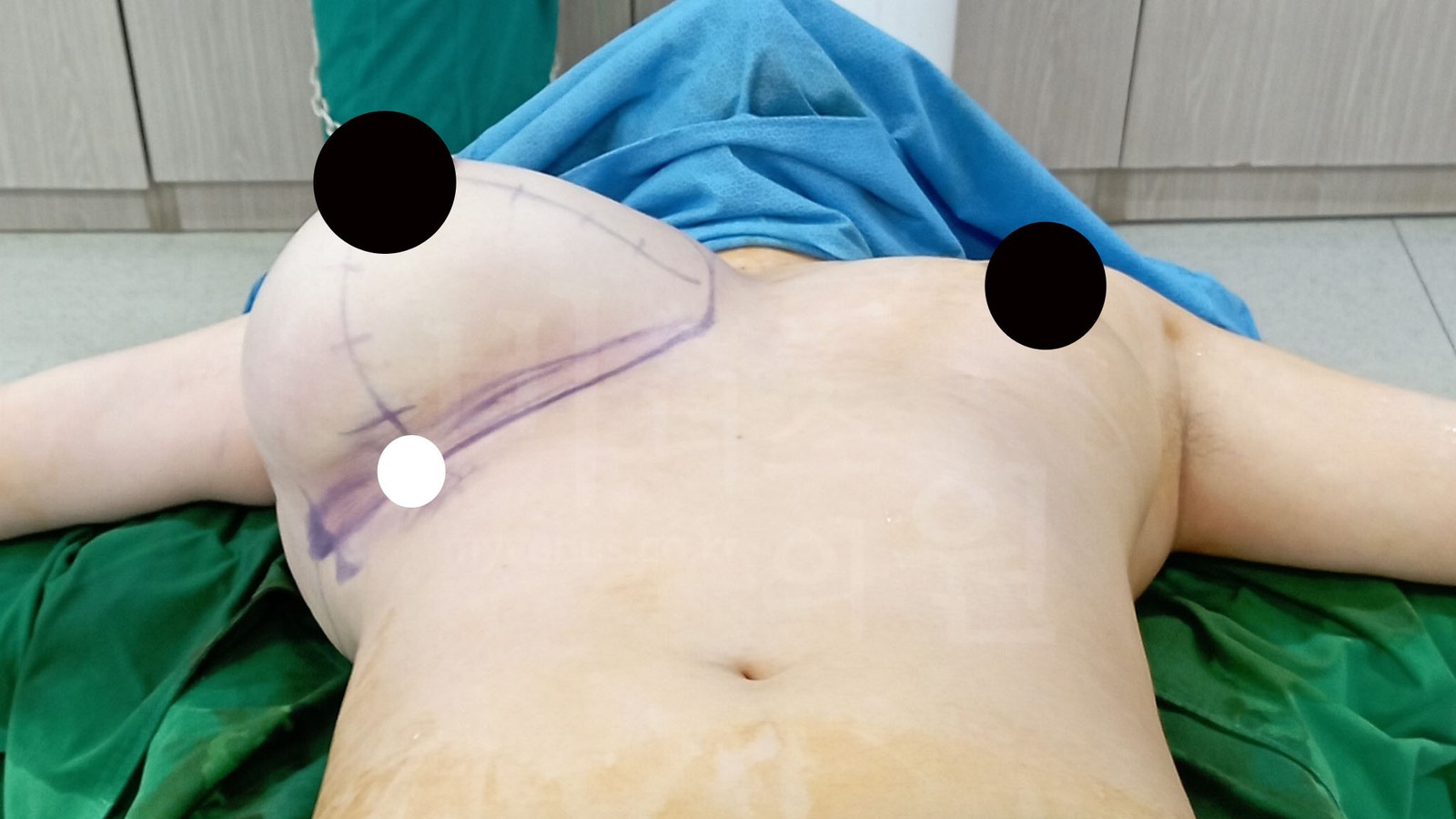 手术台上看到的右侧乳房设计与标记 (1)