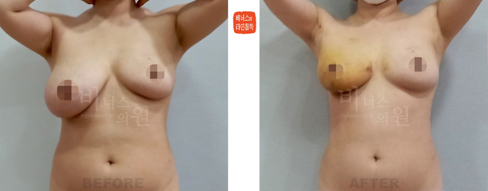 乳房不对称右侧吸脂手术前后对比 正面（术后1周）