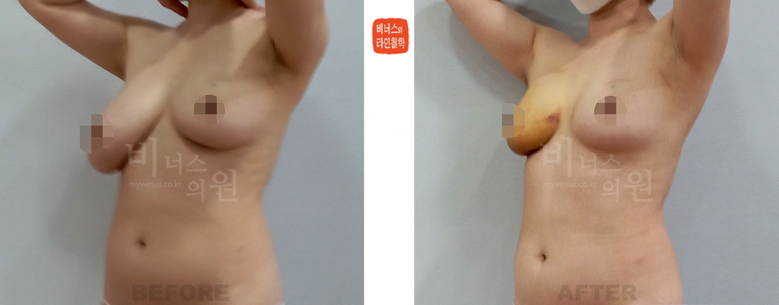 乳房不对称右侧吸脂手术前后对比 右侧45度侧面（术后1周）