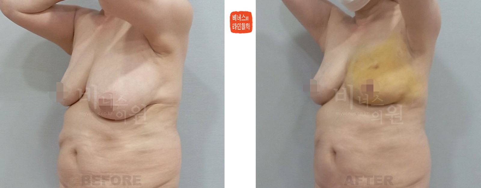 乳房不对称左侧吸脂手术前后对比 左侧45度侧面（术后1周）