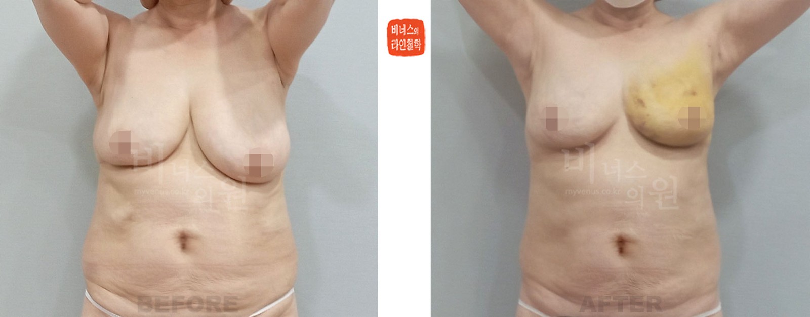 乳房不对称左侧吸脂手术前后对比 正面（术后1周）