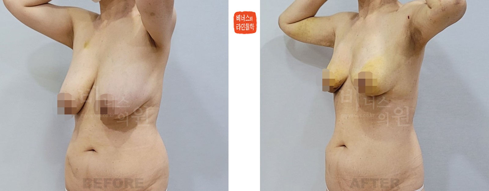 乳房缩小吸脂术前后对比照 45度侧面（术后1周）
