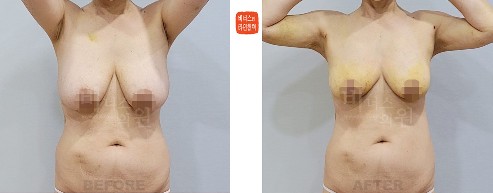 乳房缩小吸脂术前后对比照 正面（术后1周）