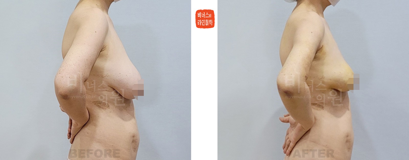 乳房缩小吸脂术前后对比照 侧面（术后1周）