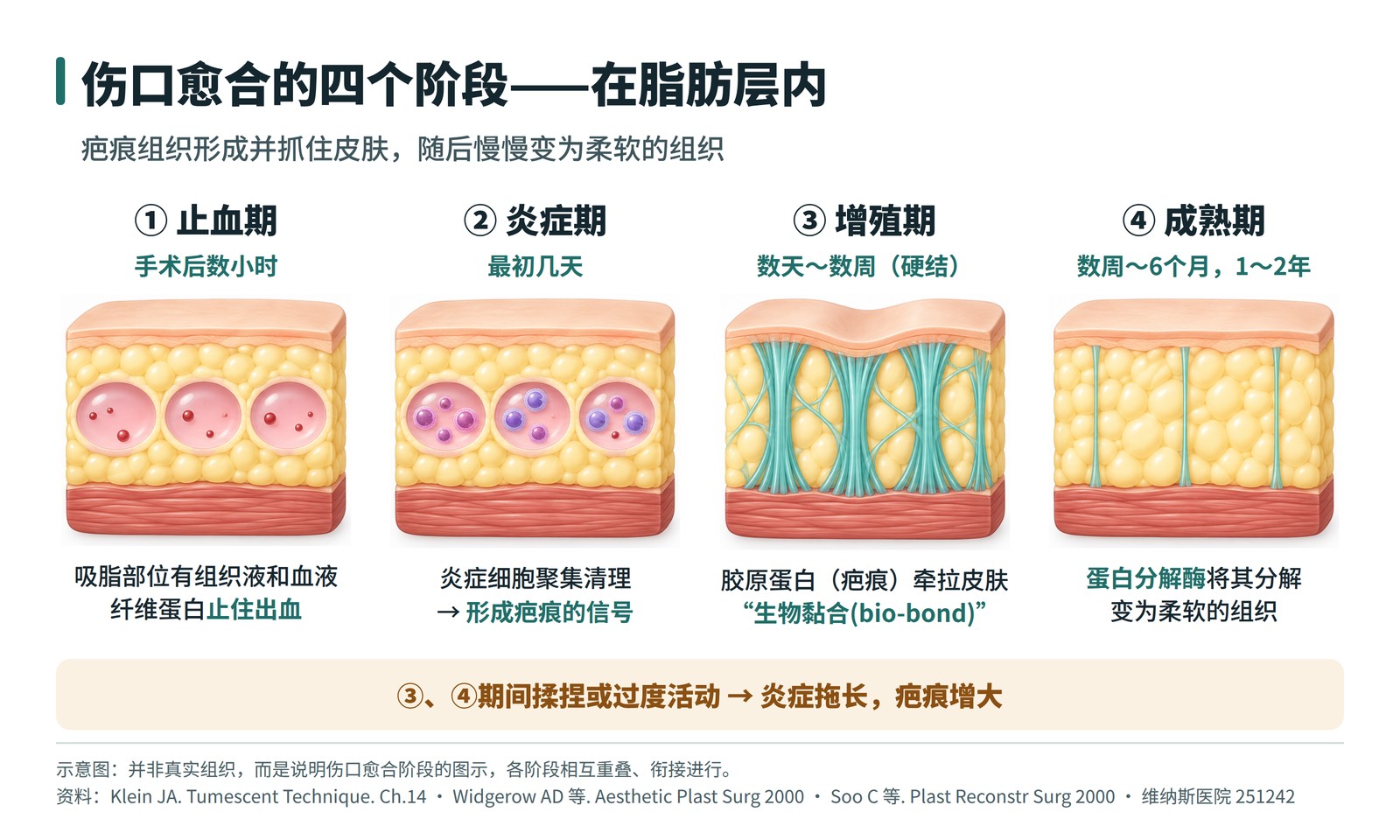 以脂肪层断面表示伤口愈合四个阶段（止血期、炎症期、增殖期、成熟期）的示意图