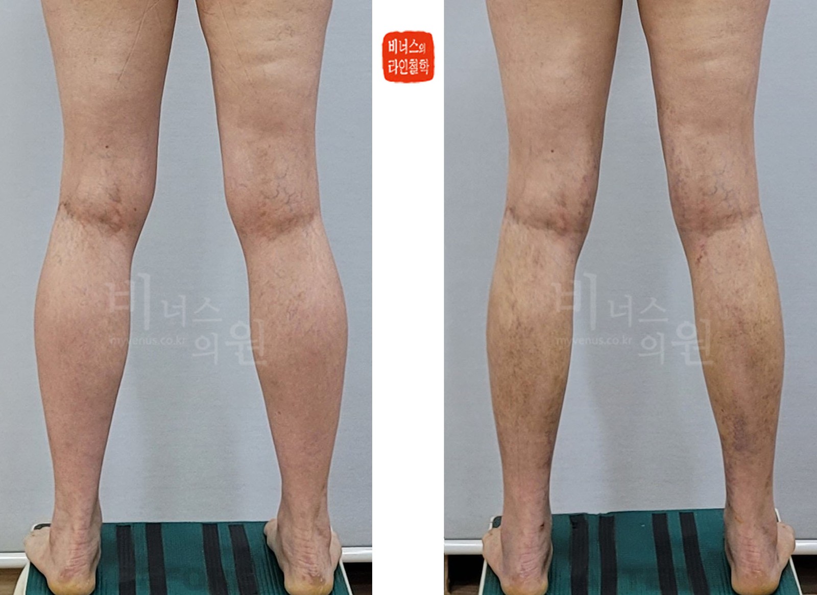 小腿吸脂前后对比照片 第一个病例 背面，双腿分开（术后第10天）