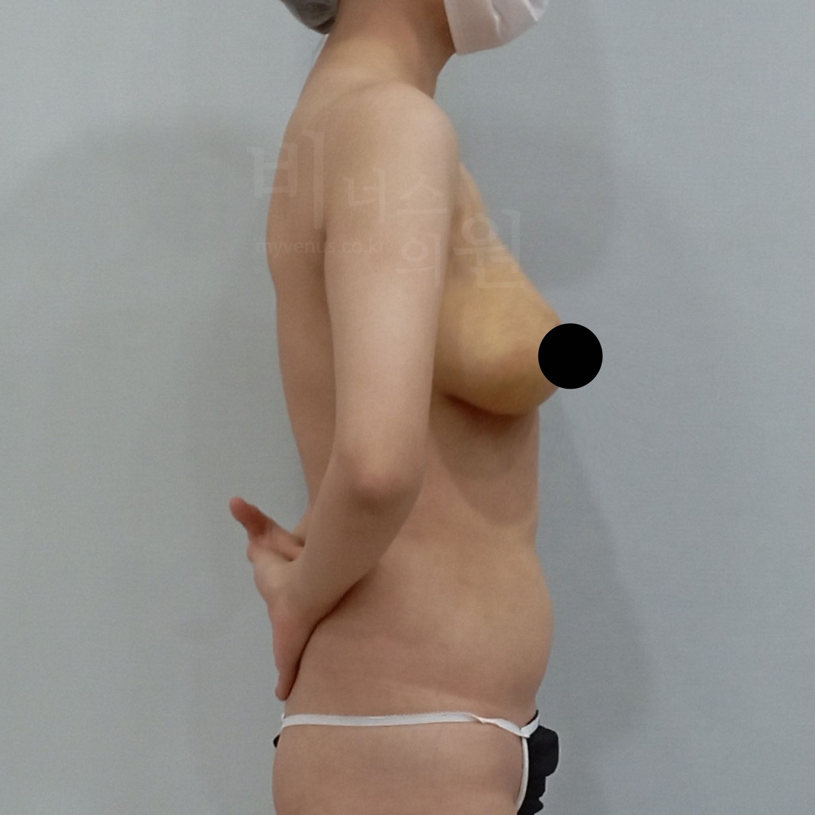 产后下垂乳房 乳房缩小吸脂 术后1周 右侧面