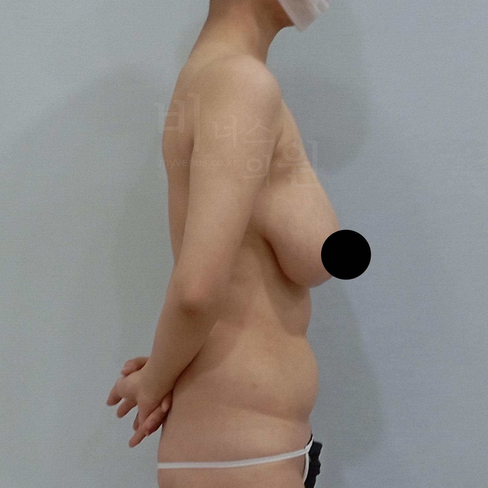 产后下垂乳房 乳房缩小吸脂 术前 右侧面