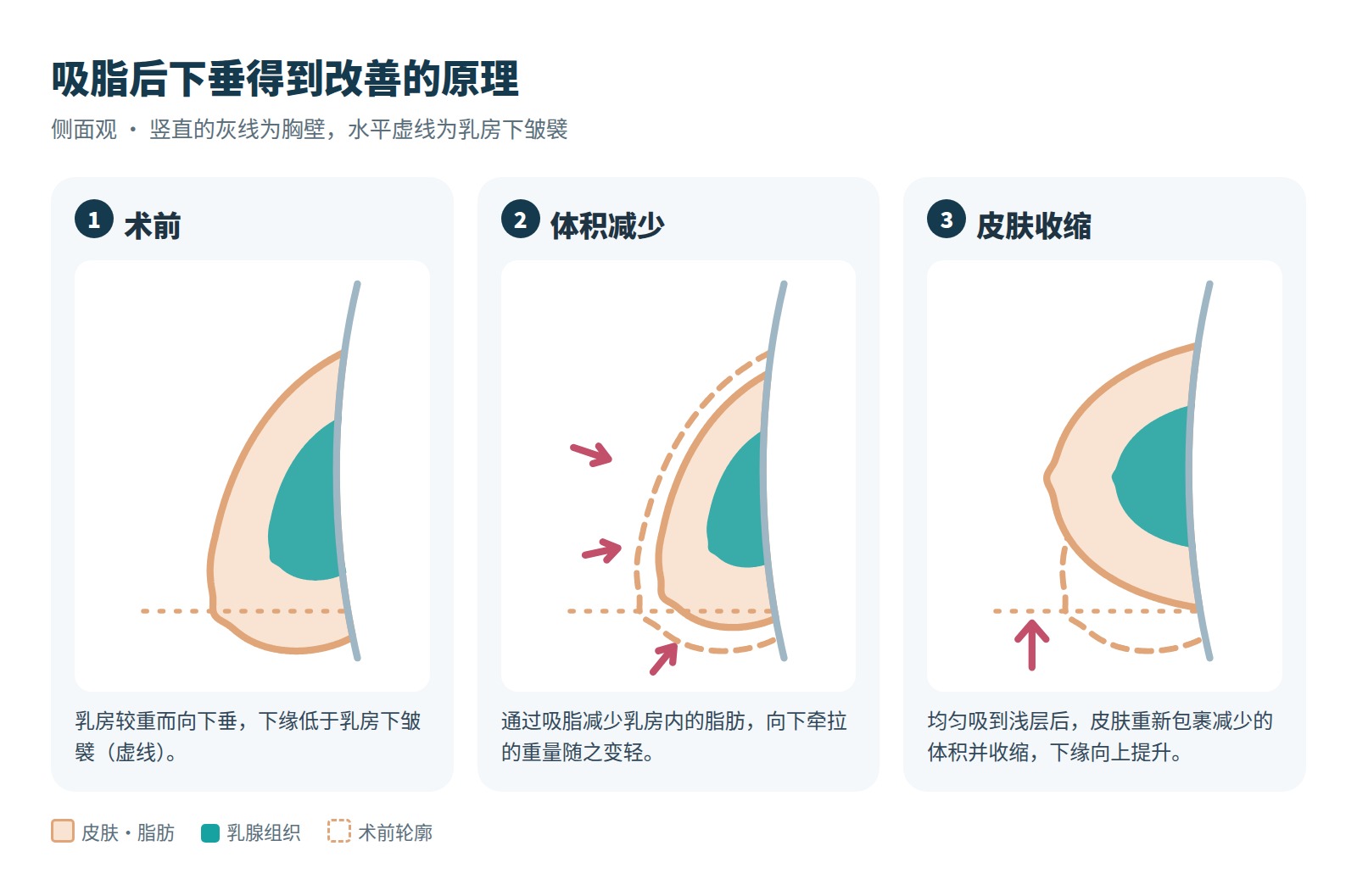 吸脂后体积减少与皮肤收缩改善下垂的原理示意图